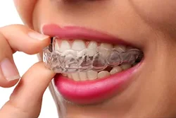 Arlington Invisalign®